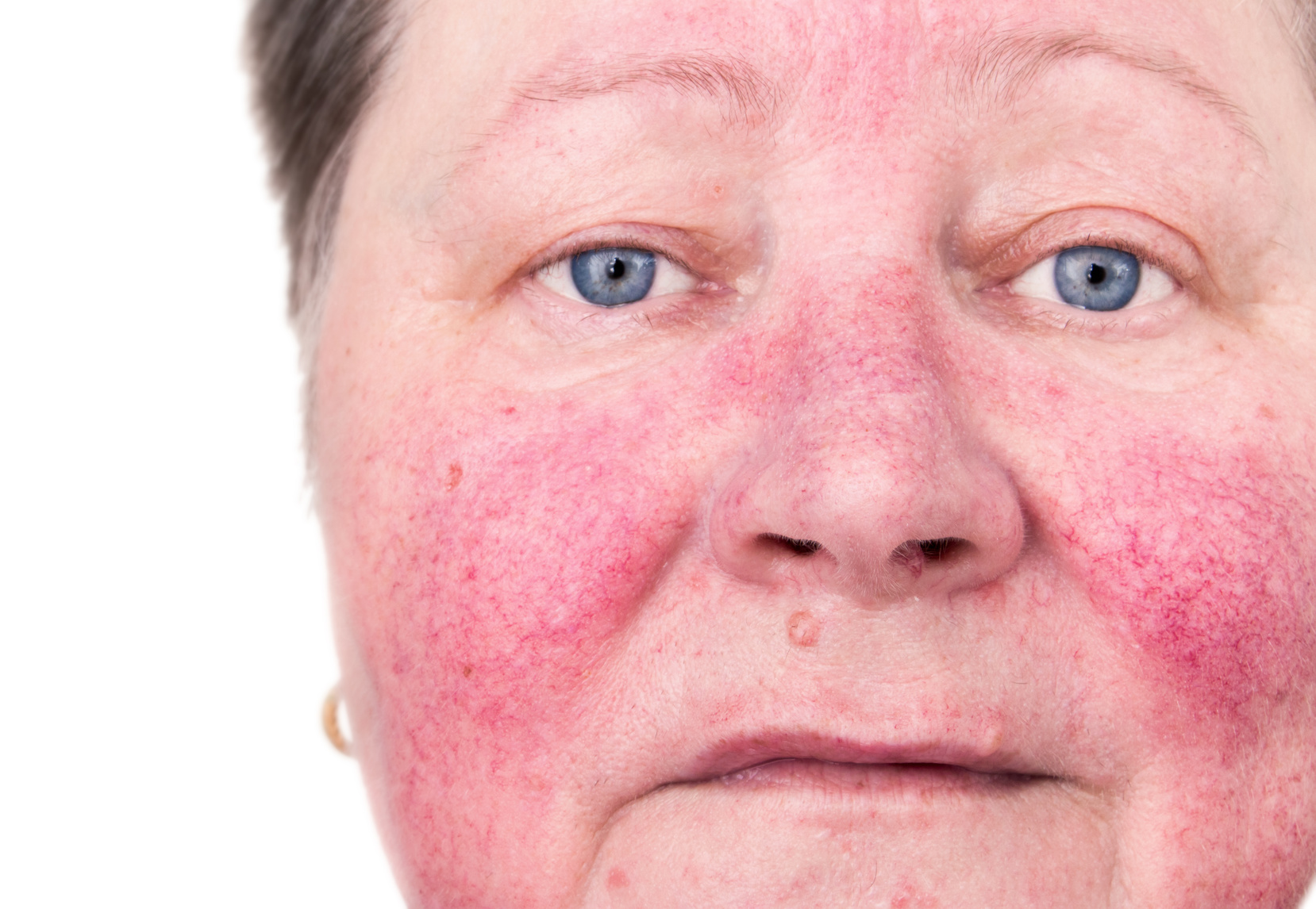 Curing Acne Rosacea, Improving Overall Health