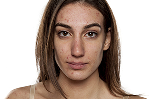 Leyla Weighs In: Getting to the root of acne
