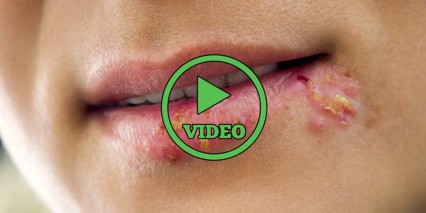 Some Facts You Absolutely Need to Know About Herpes