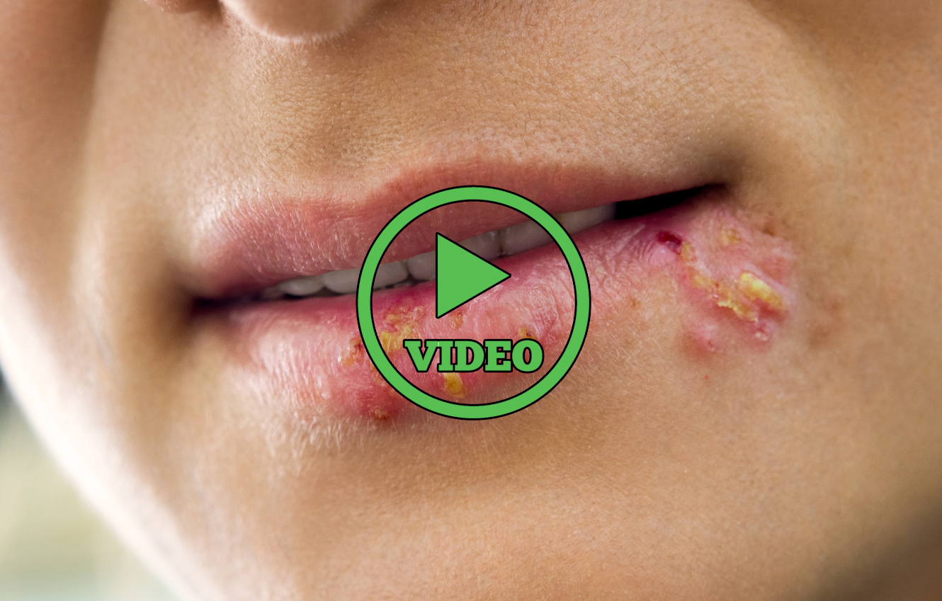 Some Facts You Absolutely Need to Know About Herpes