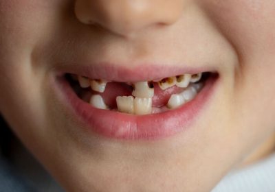 Tooth