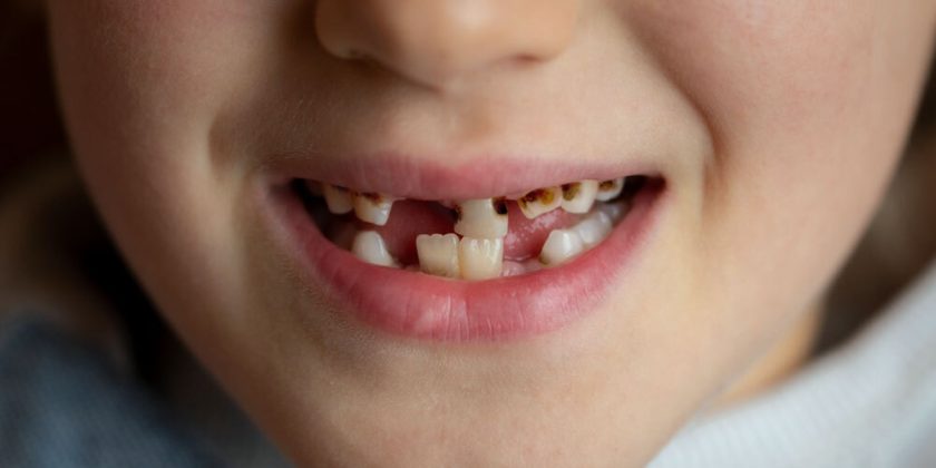 Tooth Truth: What’s Really Behind Our Children’s Cavities?